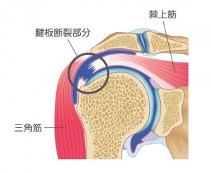 腱板