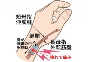 tendonitis-mechanism