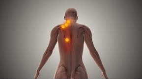 肩こり トリガーポイント⓵