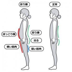 反り腰画像
