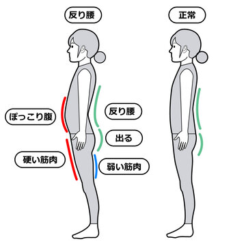 反り腰・骨盤矯正のイメージ