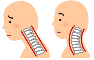 ストレートネック